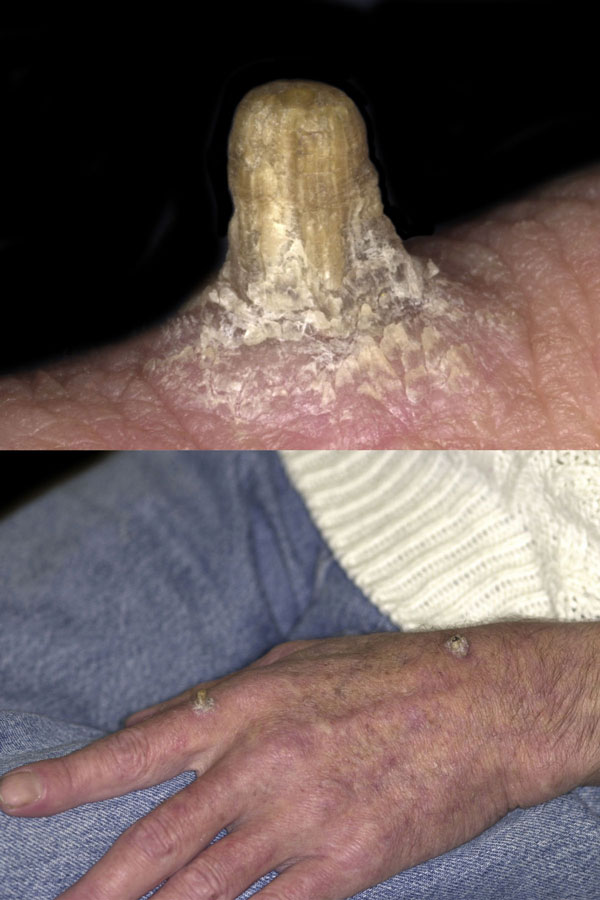 actinic keratosis horn